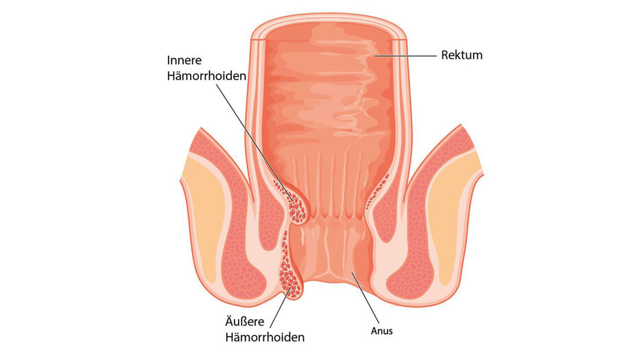 Illustrierte Abbildung eines Anus und der Hämorrhoiden.