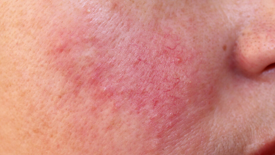 Nahaufnahme von Rosacea